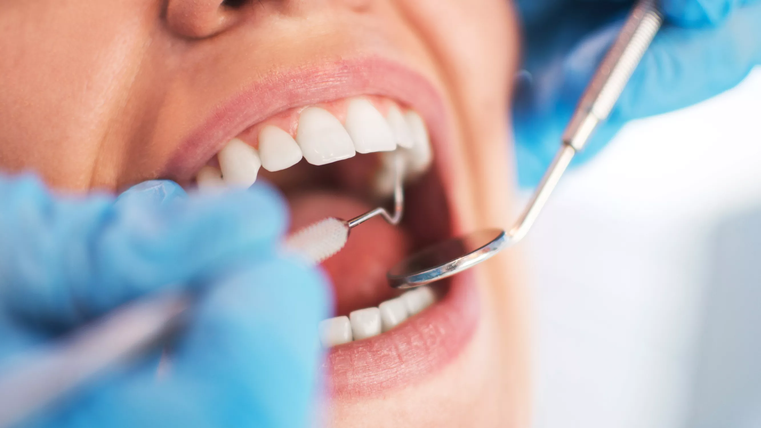 Poskiontelotulehdus voi alkaa hampaiden juurien tulehduksesta.
