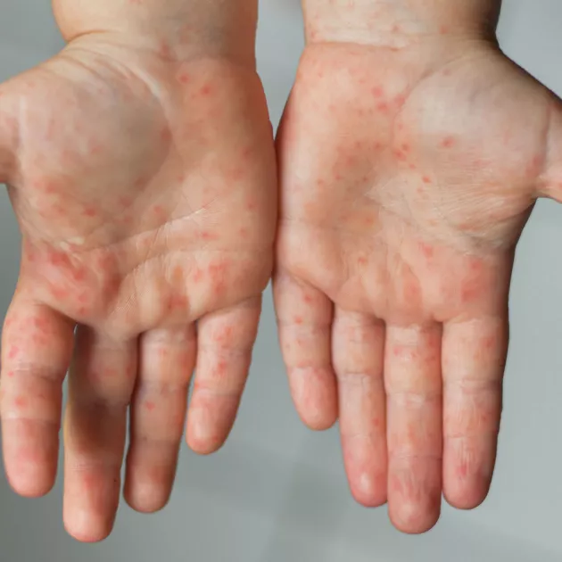 Enterovirus tarttuu herkästi. Sen tartuntareitti kulkee usein ulosteesta käsiin, käsistä toisiin ihmisiin ja edelleen käsistä suuhun.