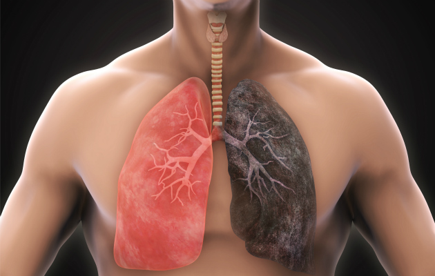 Terve keuhko eroaa selvästi tupakoitsijan keuhkosta.