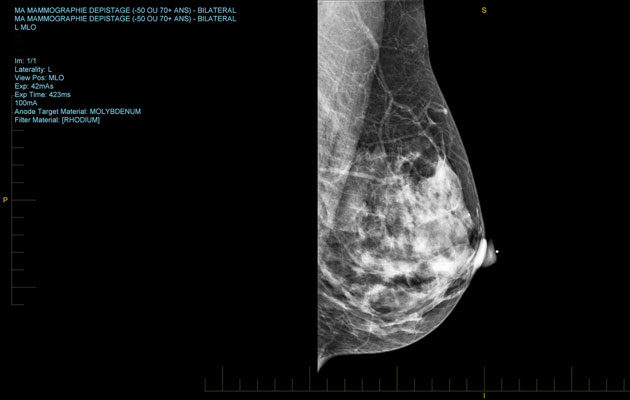 Mammografiassa ja lääkärissä kannattaa tutkituttaa rintojen terveys säännöllisesti.