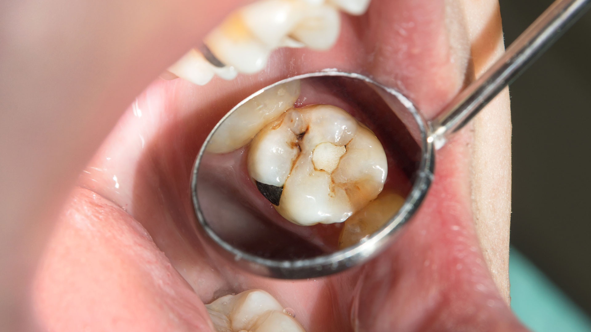 Terveet hampaat takaavat terveellisen aikuisuuden.
