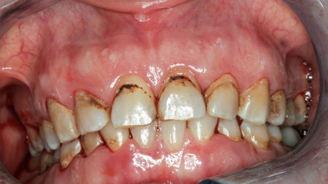 Tupakka moninkertaistaa riskin sairastua hampaiden kiinnityskudossairauteen eli parodontiittiin. Muita tupakoinnin haittavaikutuksia ovat värjäytymät, karvakieli ja pahanhajuinen hengitys.