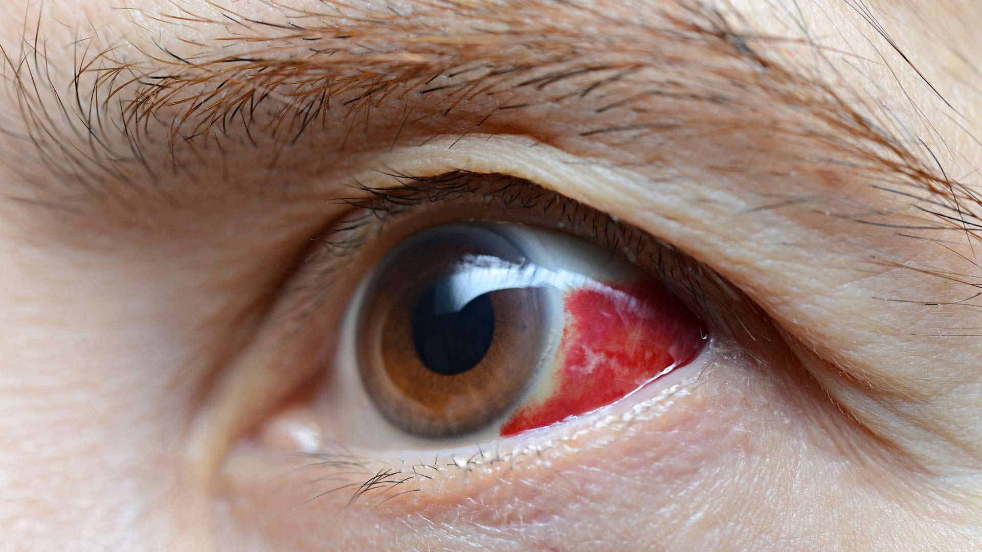 Jos silmän verisuonen katkeaminen johtuu ulkoisesta vammasta, silloin sitä täytyy lähteä näyttämään lääkärille.