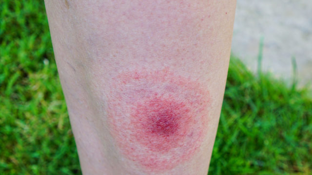 Punkkien levittämät taudit, kuten borrelioosi, ovat yleistyneet. Kuvassa borrelioosin tyypillinen merkki, punainen rengasmainen muutos ihossa.