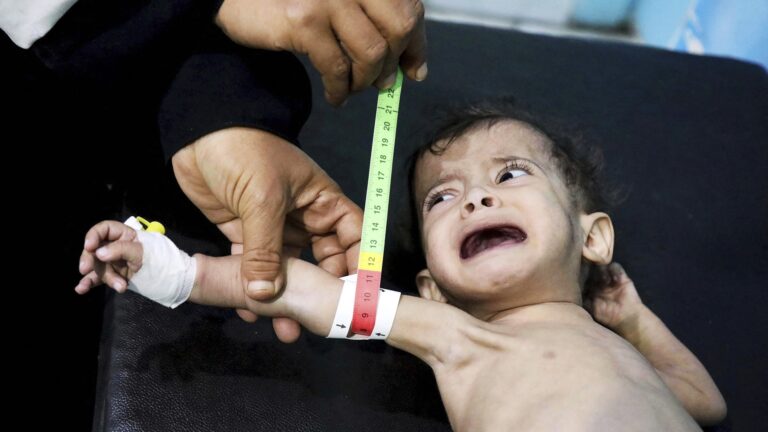 Nälänhätä on pahinta Jemenissä. Aliravittua lasta hoidetaan Jemenin kolmanneksi suurimmassa kaupungissa Taezissa. Vuosien sotiminen, talouden romahtaminen ja koronaviruspandemia on aiheuttanut ruokapulan, joka koskettaa 16,2 miljoonaa ihmistä.