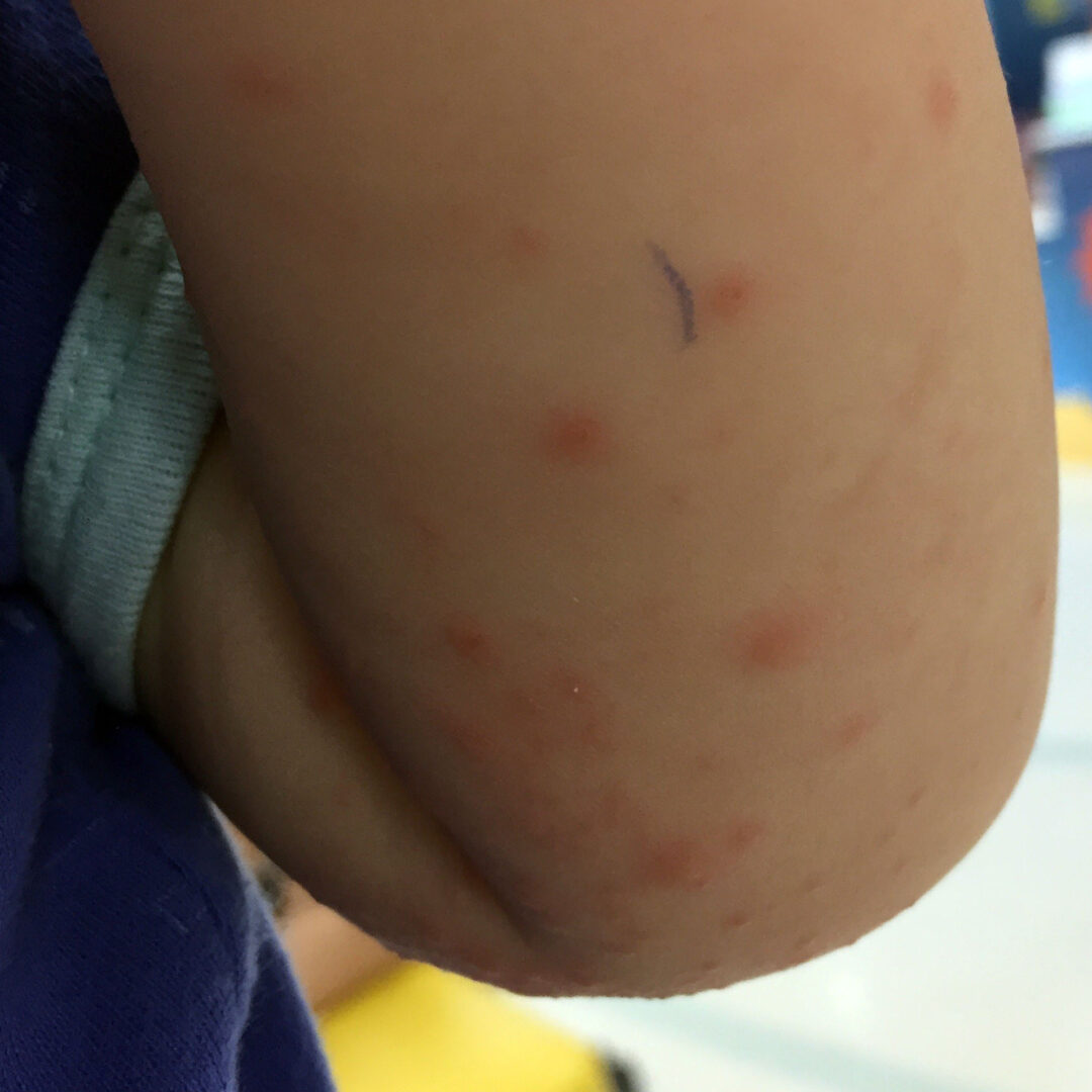 Enterorokon näppylät lapsen käsivarressa