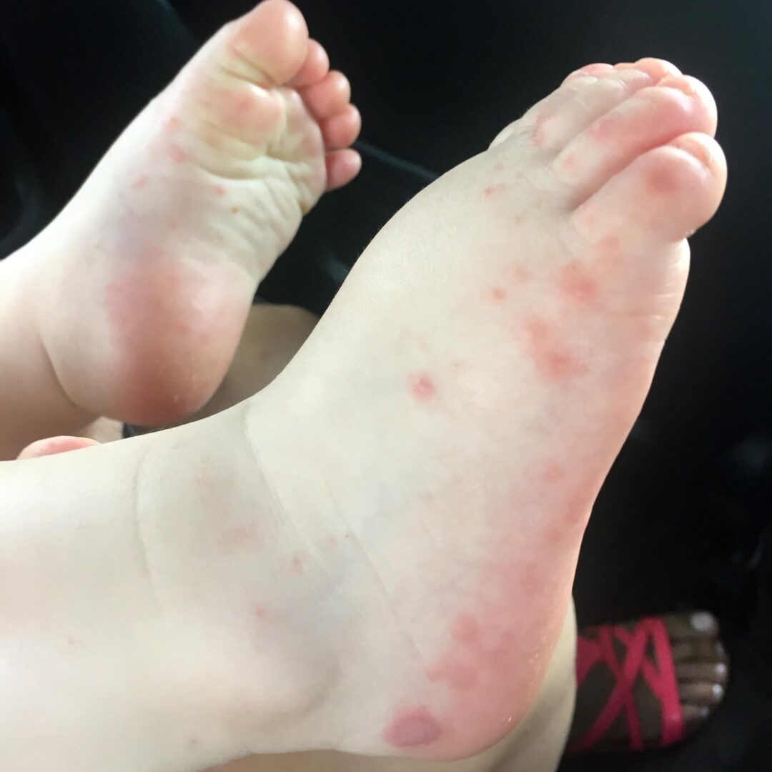 Enterorokko lapsella oireilee näppylöinä jalassa