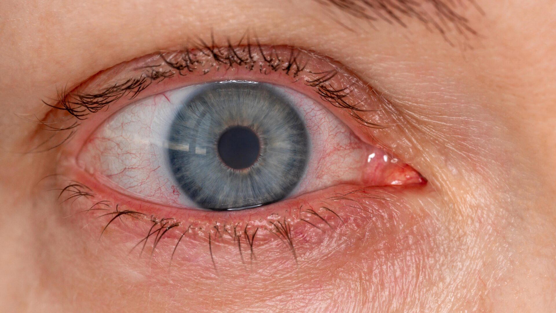 Suuri riskiryhmä mikrobeista aiheutuviin silmäinfektioihin ovat terveet, nuoret piilolinssinkäyttäjät.