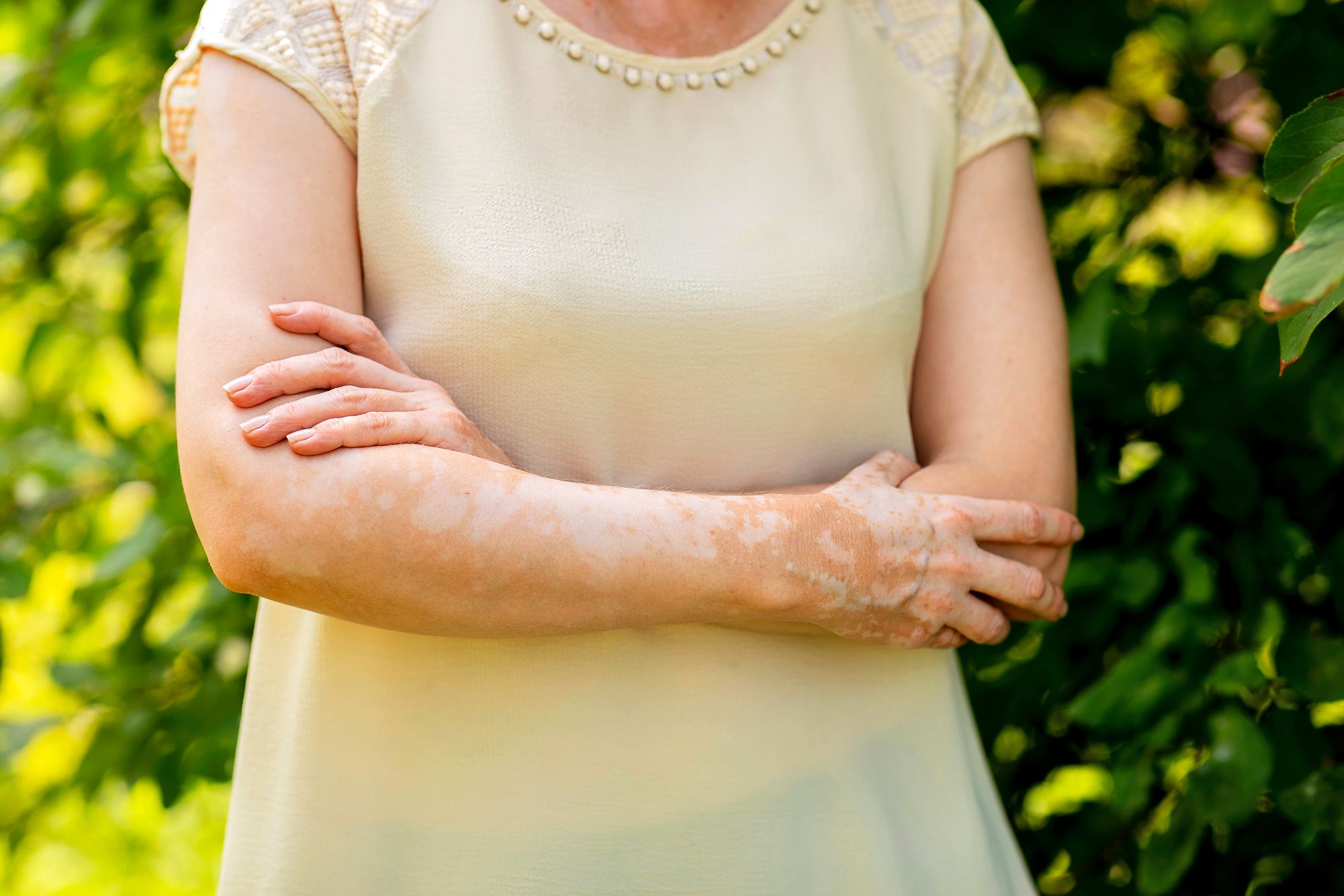 Valkopälvi eli vitiligo on vaaraton ihosairaus,