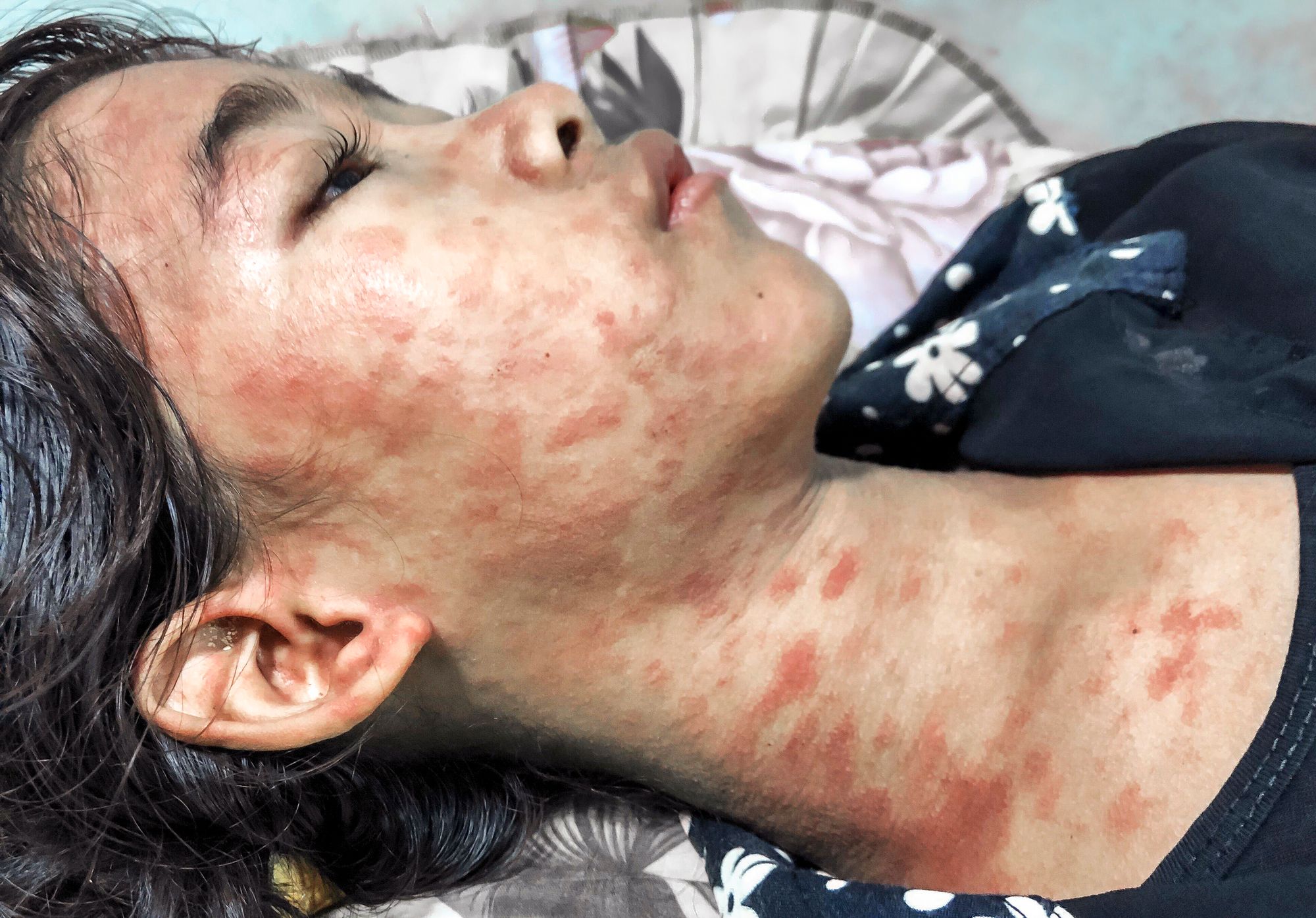 Chikungunya ­aiheuttaa uhrilleen usein voimakasta ihottumaa ja muita ihovaurioita. ©  Zay Nyi Nyi / Alamy Stock Photo