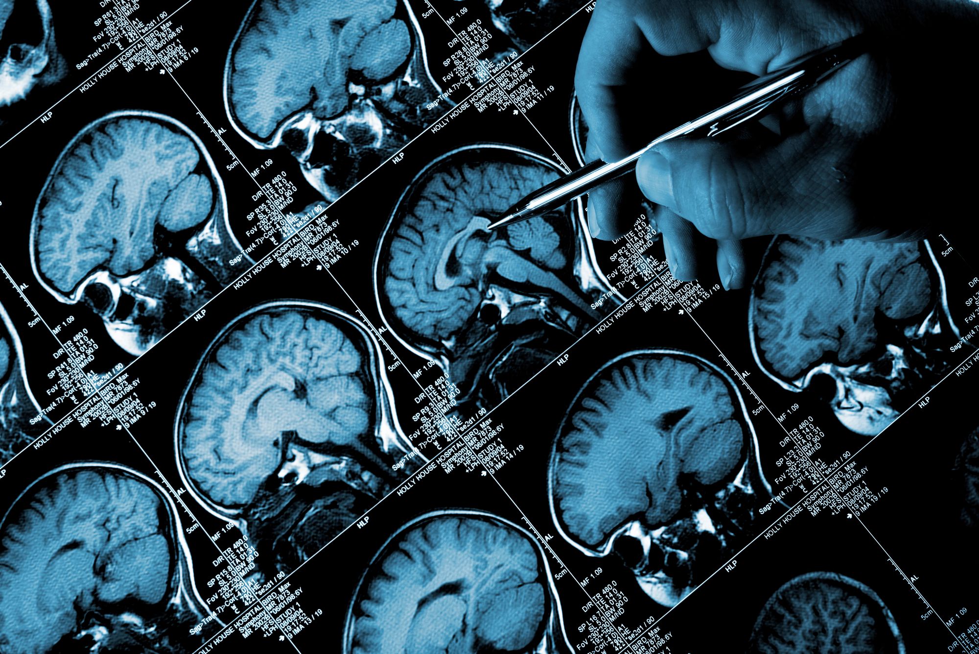 Muistioireiden syytä voidaan selvittää muun muassa aivojen magneettiku­vauksessa, jossa saadaan tarkkoja kuvia ilman säteilyä. Magneettikuvista on mahdollista erottaa esimerkiksi aivoverenkierto­häiriöiden tai Alzheimerin taudin aiheuttamia muutoksia aivoissa. © iStock
